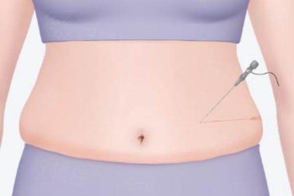 倪銘醫(yī)生吸脂多少錢