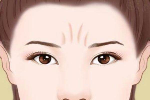 做川字紋手術(shù)要多少錢