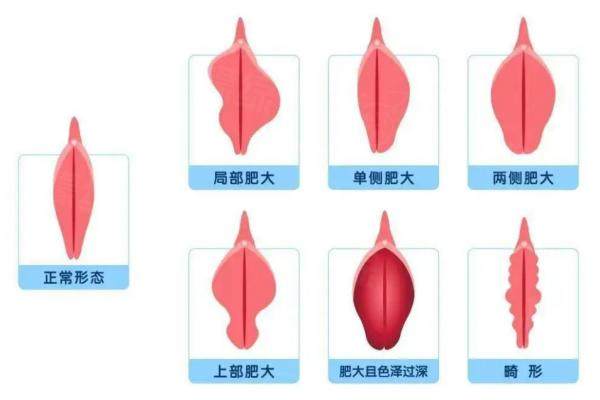 陰唇蝴蝶型饅頭型鮑魚型的區(qū)別圖片