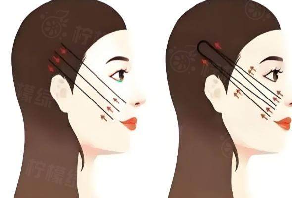 北京王志堅醫(yī)生無痕筋膜提升術(shù)多少錢