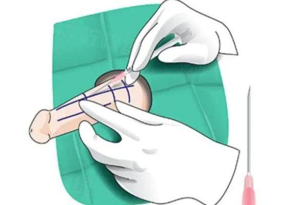 鹽城艾美莉醫(yī)院哪個(gè)醫(yī)生做男性增粗手術(shù)好