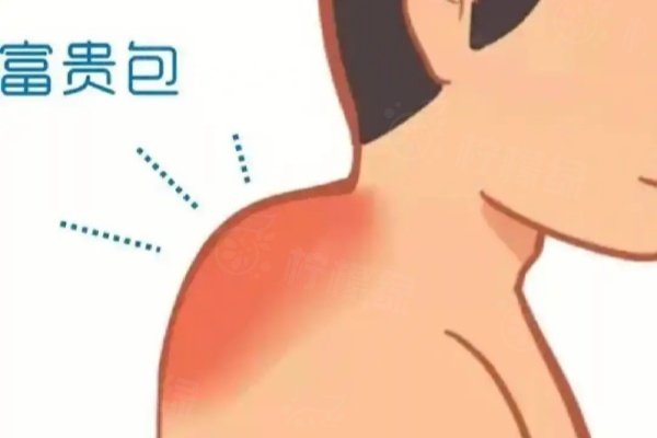 深圳治療富貴包專科醫(yī)院