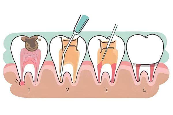 根管治療一個良心牙醫(yī)的忠告