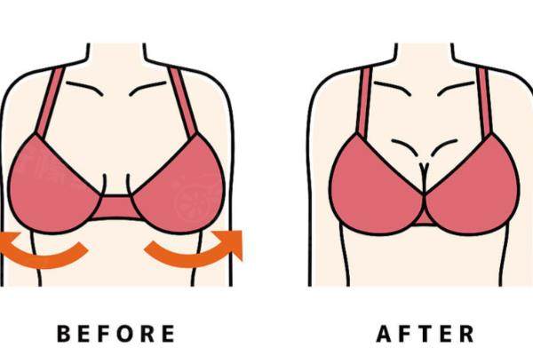 廣州做縮胸手術(shù)好的醫(yī)院有哪些