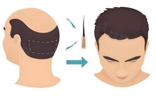 青島碧蓮盛植發(fā)醫(yī)院正規(guī)嗎