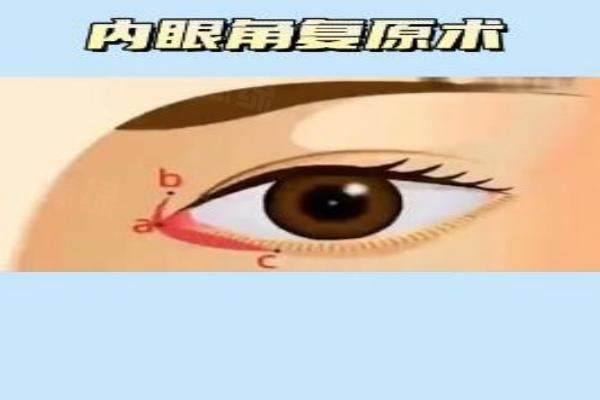 重慶金榮醫(yī)院常秀芬修復(fù)內(nèi)眼角怎么樣