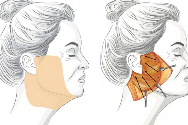 黃金超聲炮的價格是多少