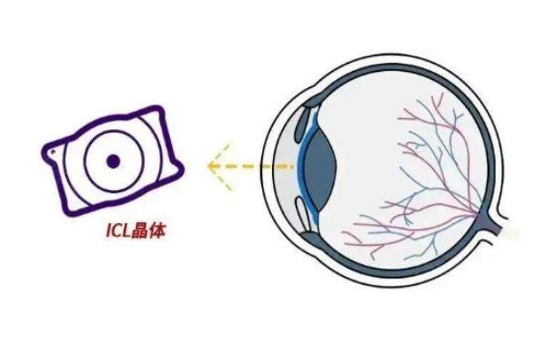 南京華廈眼科醫(yī)院近視手術(shù)價格