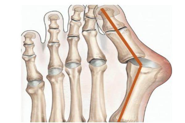 蘇敬達拇外翻手術<span style=