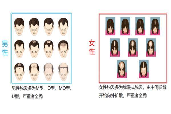 廣州曙光植發(fā)1980元是不是真的