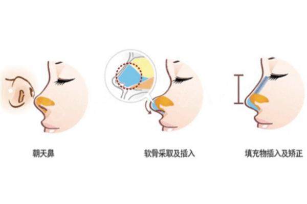 國(guó)內(nèi)十大鼻修復(fù)醫(yī)生