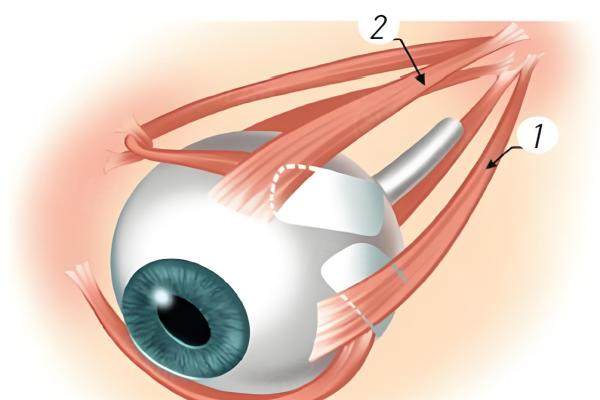 國內(nèi)后鞏膜加固術(shù)醫(yī)生排名前三