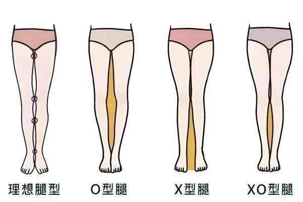 腿型矯正手術(shù)多少錢