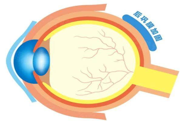 國內(nèi)后鞏膜加固術(shù)哪個(gè)醫(yī)生做的好
