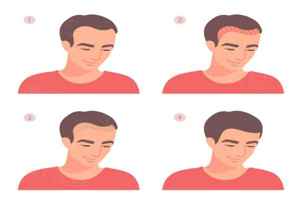 男士種頭發(fā)一般多少錢