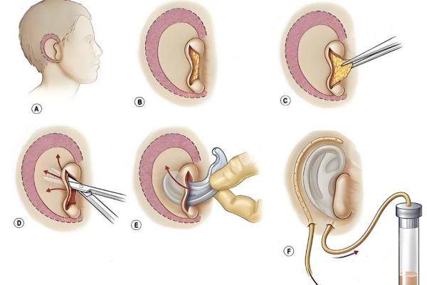 廣州高尚醫(yī)院黃金龍醫(yī)生做貼發(fā)耳矯正術(shù)成效
