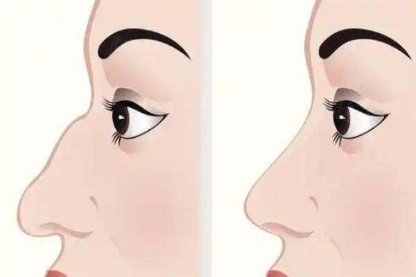 溫科磊醫(yī)生做鼻子怎么樣