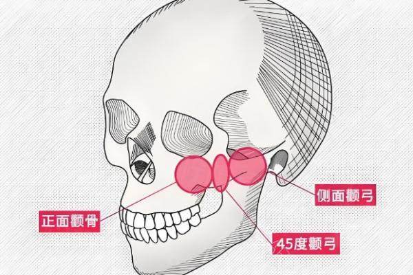 有人做過王東一針降顴骨嗎