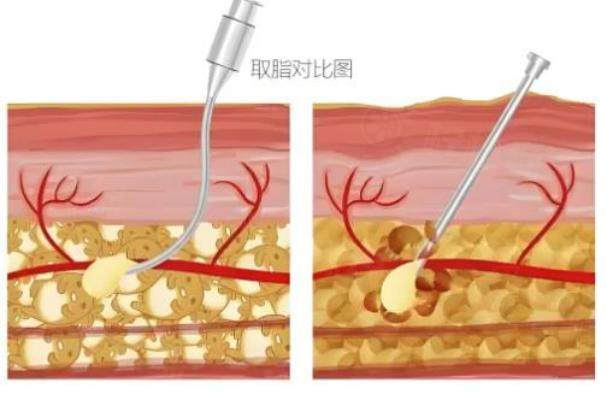 北京王東醫(yī)生吸脂多少錢