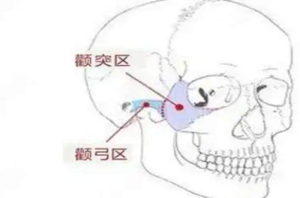 王東醫(yī)生做一針降顴骨的手術好嗎