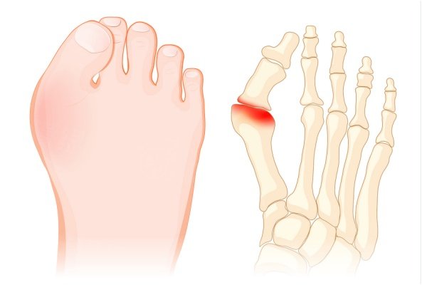 蘭州大腳骨手術(shù)醫(yī)院排名榜
