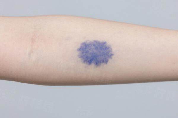 廣州去胎記醫(yī)院哪家好