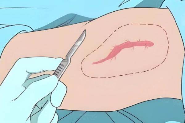 陳業(yè)忠治療疤痕好嗎