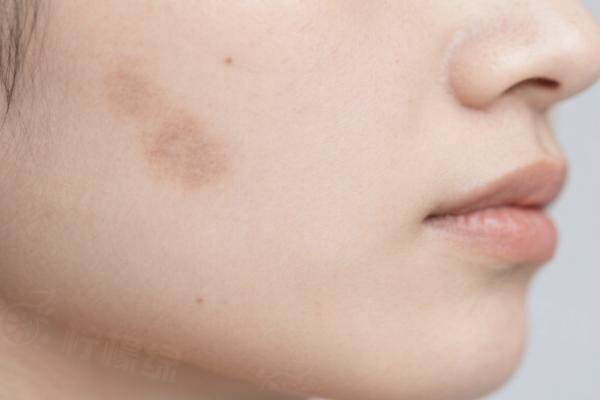 廣州去胎記哪個(gè)醫(yī)院強(qiáng)