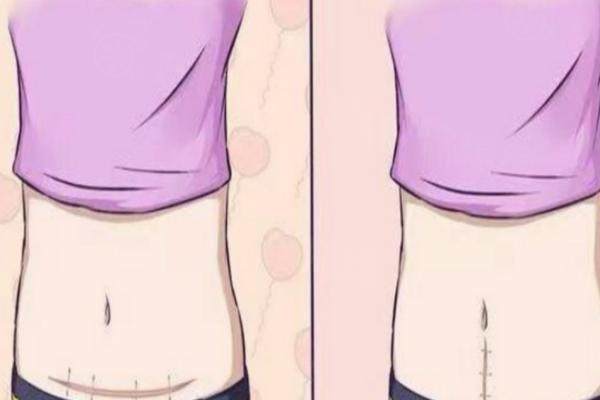 國(guó)內(nèi)做腹壁成形術(shù)醫(yī)生推薦