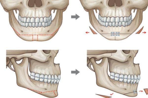 頦成型手術(shù)和墊下巴那個(gè)風(fēng)險(xiǎn)更大