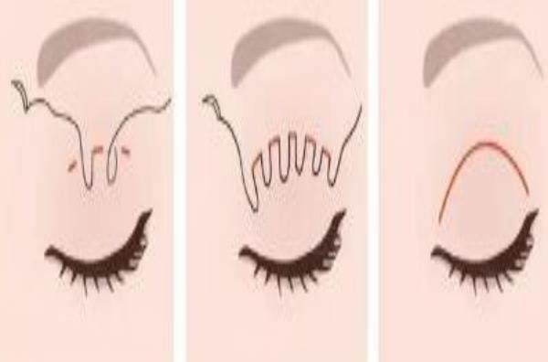 石家莊王亞斌醫(yī)生做雙眼皮多少錢