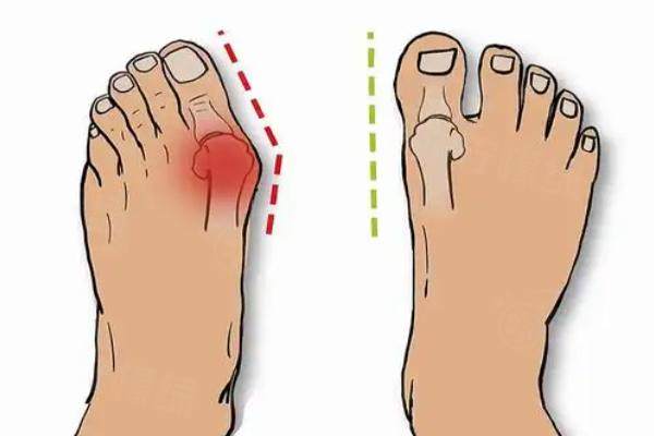 上海虹橋醫(yī)院治大腳骨多少錢