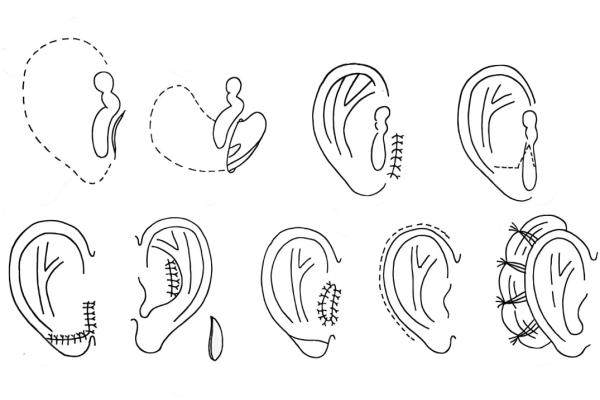 余文林唇裂修復(fù)怎么樣