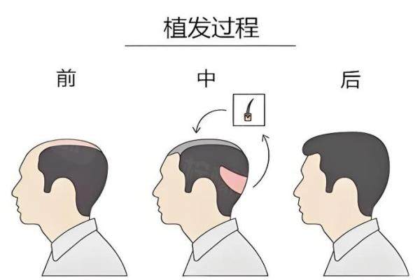 北京熙朵植發(fā)醫(yī)院靠譜嗎