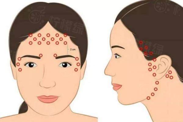 英倫大提升注射點(diǎn)位