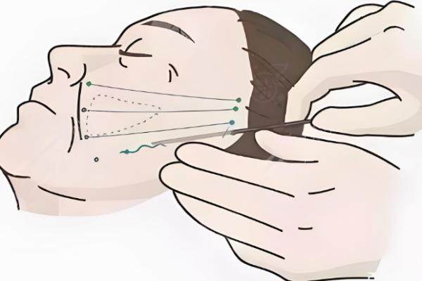 北京隋冰拉皮實(shí)例