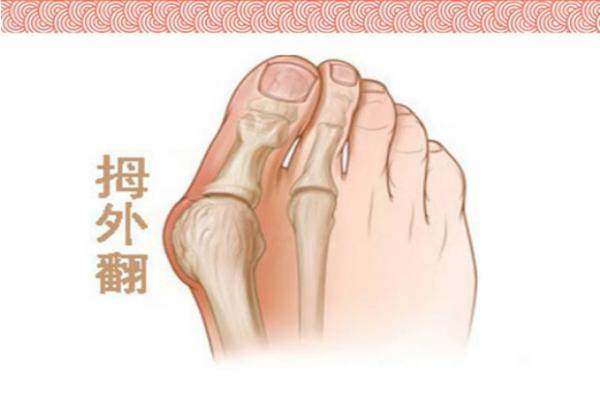 上海虹橋醫(yī)院治療拇外翻成效怎么樣