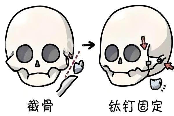 徐威強(qiáng)磨骨實(shí)例