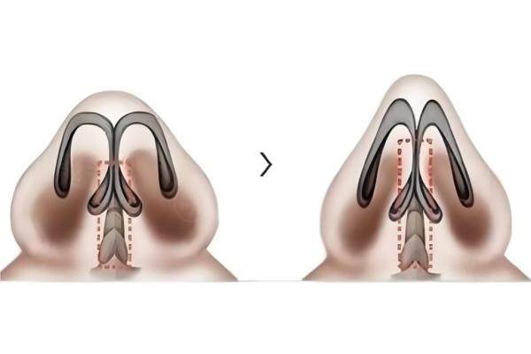 胡凱醫(yī)生鼻子手術(shù)成效