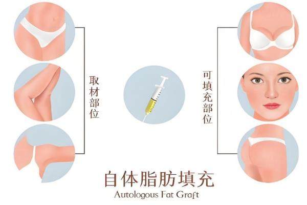 廣州做脂肪填充多少錢
