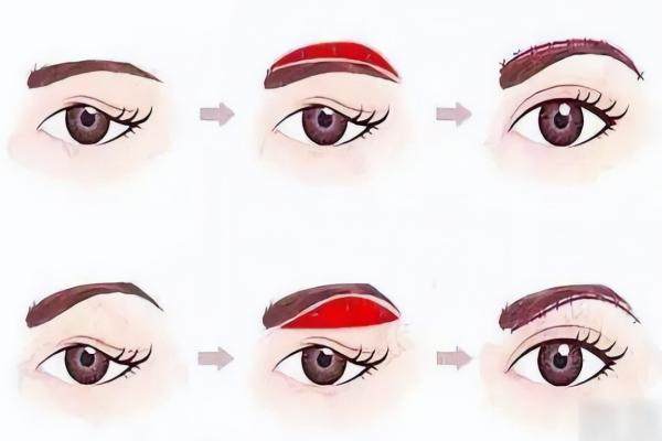 提眉懸吊跟普通提眉的區(qū)別