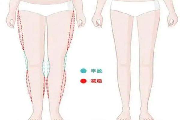 杭州維多利亞做大腿吸脂怎么樣