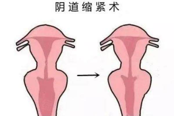 北京任琳醫(yī)生做私密手術(shù)口碑如何