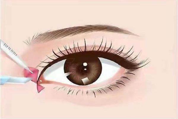 王恒醫(yī)生內(nèi)眼角修復(fù)怎么樣