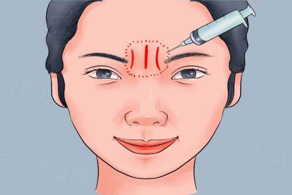 李廣學(xué)真皮填充川字紋多少錢