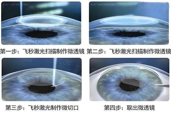 西安四院眼科近視手術(shù)費是多少