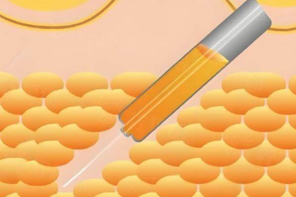 張讓虎吸脂厲 害三個地方