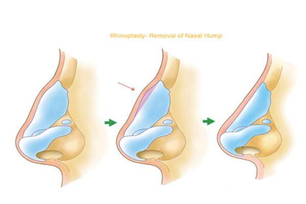 隆鼻假體取出后丑爆了