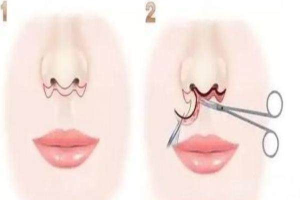 張曼醫(yī)生做人中手術(shù)費(fèi)用