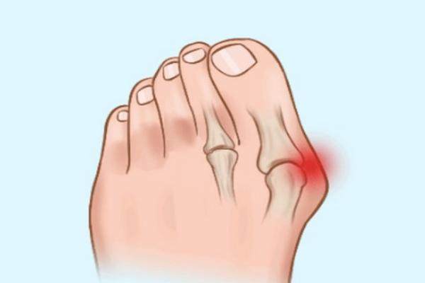 蘇敬達(dá)拇外翻手術(shù)評(píng)價(jià)